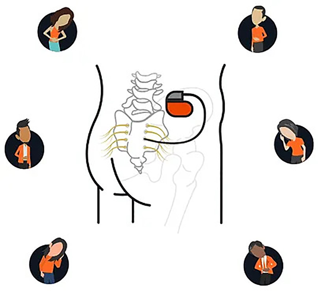 Imagen: Un ensayo clínico está evaluando el dispositivo bioelectrónico innovador para la enfermedad inflamatoria intestinal (Fotografía cortesía de Boomerang Medical)