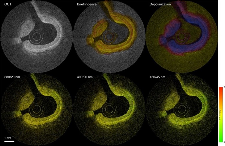 Imagen: El dispositivo basado en catéter combina PS OCT (arriba) y FLIM multiespectral (abajo) para proporcionar una vista multimodal detallada a través de imágenes intravasculares (Fotografía cortesía de UC Davis)