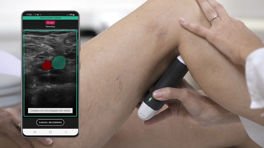 Imagen: El sistema de ultrasonido guiado por IA puede acelerar el diagnóstico de varias horas a tan solo 15 minutos (foto cortesía de Clarius Mobile Health)