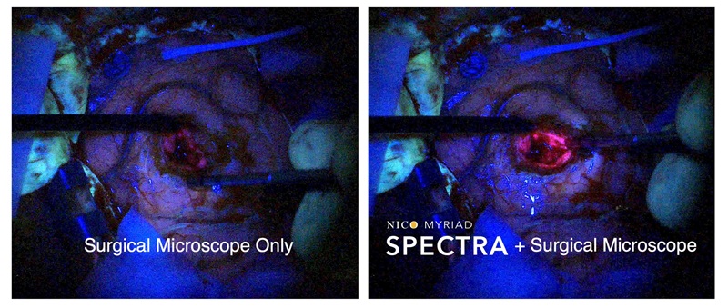 Imagen: NICO SPECTRA es la única tecnología de mano que ofrece luz azul más cercana al objetivo para mejorar la fluorescencia tisular (Foto cortesía de Nico Corporation)