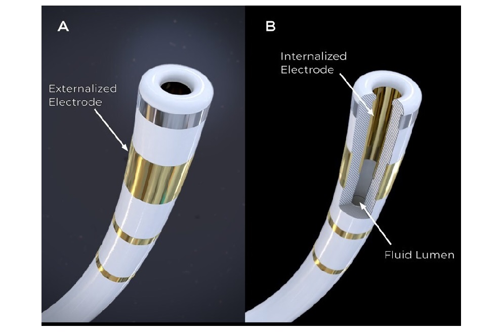 Imagen: El catéter FieldForce es el primer y único catéter PFA de fuerza de contacto optimizado para los ventrículos (foto cortesía de Field Medical)