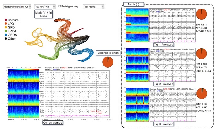Imagen: Una lectura completa del nuevo algoritmo de IA que ayuda a leer el EEG (foto cortesía de la Universidad de Duke)