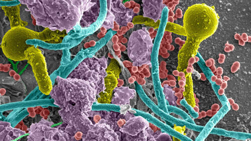 Imagen: Una infección polimicrobiana en una vejiga cateterizada (foto cortesía de Flores-Mireles Lab)