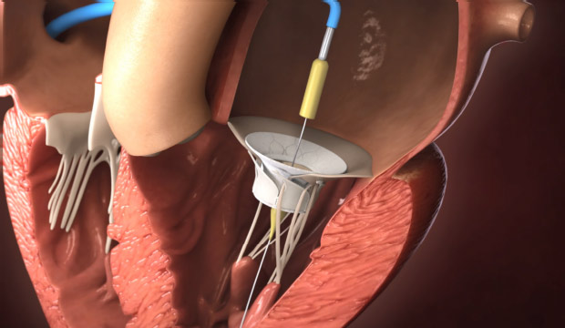 Imagen:El sistema de administración transeptal de Innovalve está diseñado para permitir el despliegue seguro del implante Innovalve (foto cortesía de Innovalve Bio)