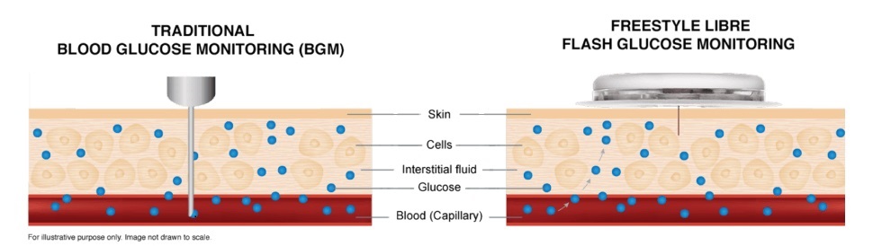 Imagen: La asociación permitirá que los sensores CGM basados ​​en la tecnología de detección FreeStyle Libre de Abbott se integren con los sistemas de administración de insulina de Medtronic (Foto cortesía de Abbott)