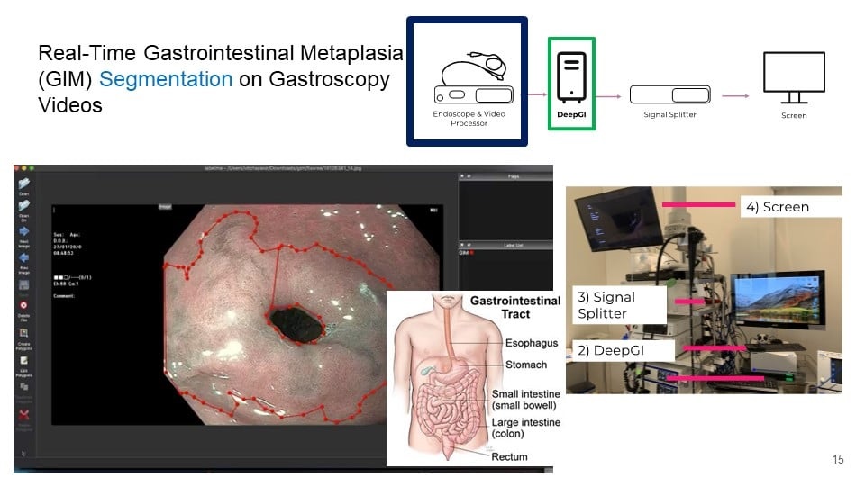 Imagen: El procedimiento del sistema de detección de trastornos gastrointestinales (DeepGI) (foto cortesía de la Universidad de Chulalongkorn)