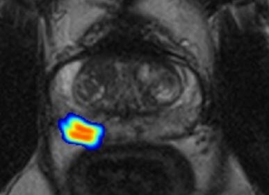 Imagen: La IA podría ayudar a evitar biopsias innecesarias para hombres con bajo riesgo de cáncer de próstata (foto cortesía de Bonekamp/DKFZ) Imagen: La IA podría ayudar a evitar biopsias innecesarias para hombres con bajo riesgo de cáncer de próstata (foto cortesía de Bonekamp/DKFZ)