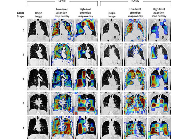Imagen: Los mapas de atención de bajo y alto nivel para individuos en cada etapa GOLD para las CNN I y E (Foto cortesía de Radiology: Cardiothoracic Imaging, doi.org/10.1148/ryct.240005)