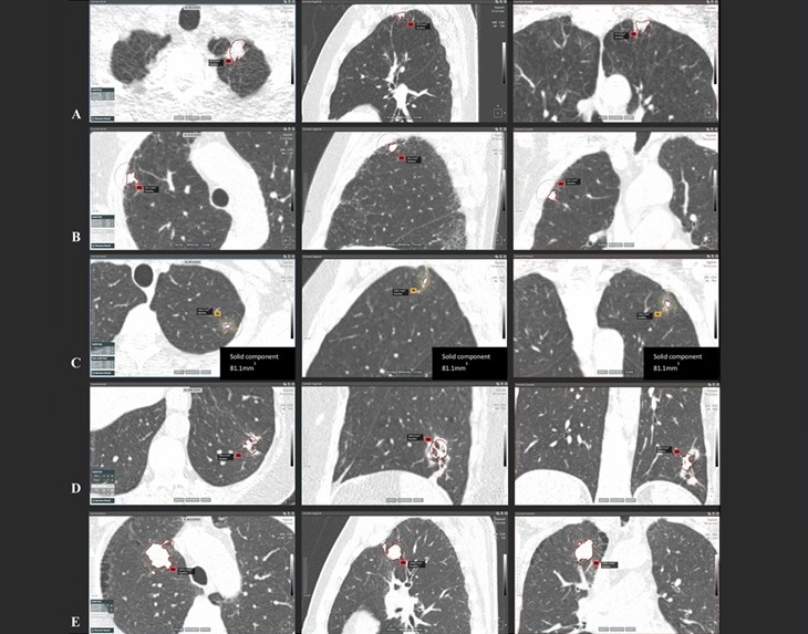 Imagen: Casos de cáncer de pulmón confirmados histológicamente detectados en referencia inmediata espués de una exploración inicial o un seguimiento a corto plazo de 3 meses. (Foto cortesía de DOI: 10.1016/j.ejca.2025.115324) Imagen: Casos de cáncer de pulmón confirmados histológicamente detectados en referencia inmediata espués de una exploración inicial o un seguimiento a corto plazo de 3 meses. (Foto cortesía de DOI: 10.1016/j.ejca.2025.115324)