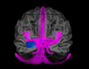 Imagen: Una posible ubicación segura para un implante visual (en azul) mientras las venas (rosas) que cubren la corteza visual permanecen intactas (foto cortesía de Precision Clinical Medicine, DOI: 10.1093/pcmedi/pbaf003)