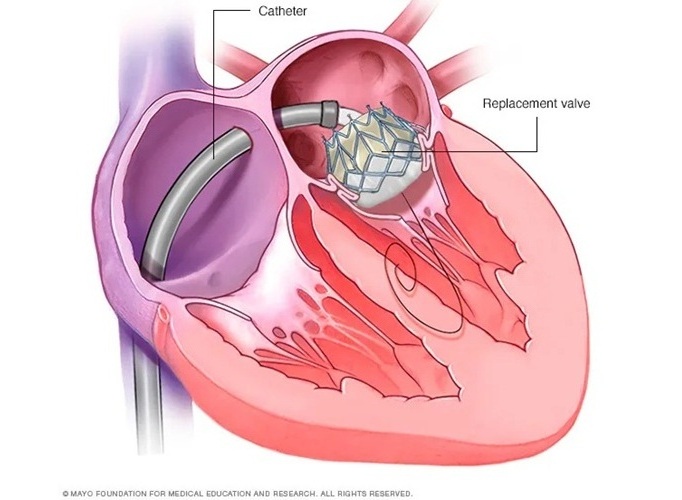 Imagen: pacientes sometidos a TMVR experimentan un menor riesgo de obstrucción y tiempos de procedimiento más cortos (foto cortesía de Mayo Clinic) Imagen: pacientes sometidos a TMVR experimentan un menor riesgo de obstrucción y tiempos de procedimiento más cortos (foto cortesía de Mayo Clinic)
