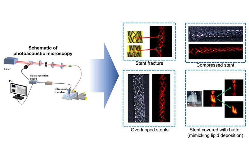 Imagen: los investigadores utilizaron microscopía fotoacústica para obtener imágenes de stents a través de la piel (foto cortesía de Myeongsu Seong/Xi’an Jiaotong-Liverpool University)