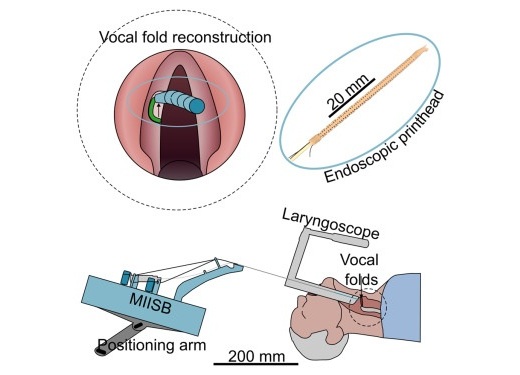 Imagen: resumen gráfico que muestra un método de bioimpresión in situ mínimamente invasivo para la reconstrucción de las cuerdas vocales (SAT Groen et al., Device (2025). DOI: 10.1016/j.device.2025.100973)