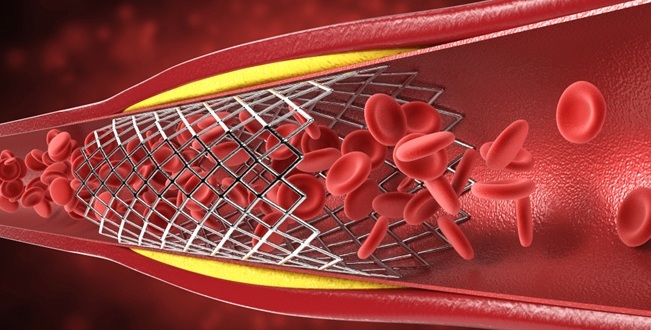 Imagen: Abrir todas las arterias coronarias bloqueadas puede mejorar significativamente la supervivencia a largo plazo después de un ataque cardíaco (Foto cortesía de Shutterstock)