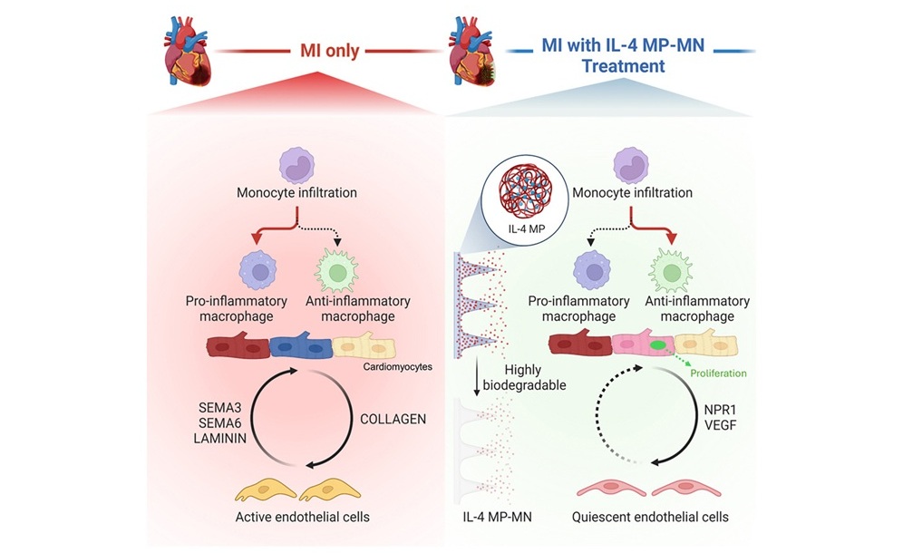 Imagen: el parche cardíaco biodegradable está diseñado para la inmunomodulación localizada y la reparación cardíaca tras un infarto agudo de miocardio (Ke Huang et al., Cell Biomaterials (2025); DOI: 10.1016/j.celbio.2025.100152) Imagen: el parche cardíaco biodegradable está diseñado para la inmunomodulación localizada y la reparación cardíaca tras un infarto agudo de miocardio (Ke Huang et al., Cell Biomaterials (2025); DOI: 10.1016/j.celbio.2025.100152)