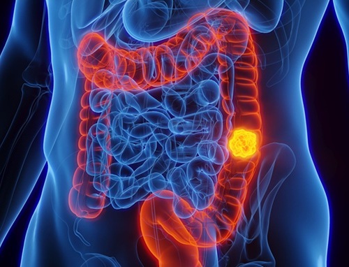 Imagen: la IA ha mejorado notablemente la detección del cáncer de colon en los últimos cinco años (Fotografía cortesía de la Universidad de Sharjah)