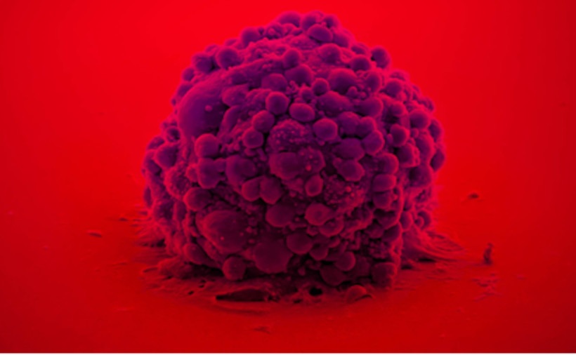 Imagen: el parche cerebral bioadhesivo administra terapia oxidativa localizada después de la extirpación del tumor (Fotografía cortesía de la UAB)