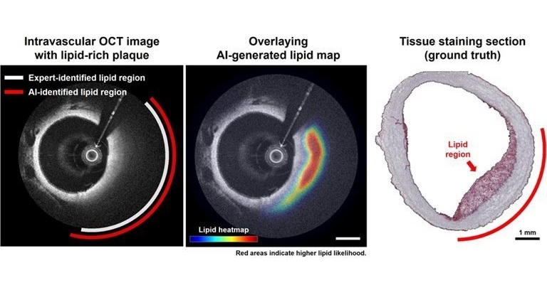 Imagen: El enfoque basado en IA identifica regiones lipídicas que coinciden bien con los resultados histopatológicos (Fotografía cortesía de Hyeong Soo Nam/KAIST)
