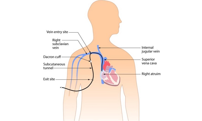 Imagen: Los catéteres insertados a través de la arteria subclavia son menos propensos a infecciones en comparación con las vías yugular y femoral  (Glynda Rees Doyle & Jodie Anita McCutcheon, CC BY 4.0)