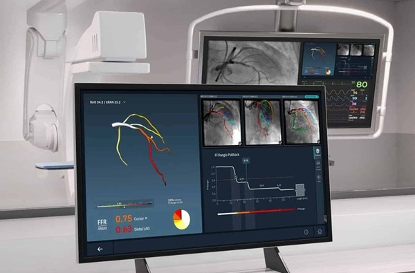 Imagen: FFRangio combina inteligencia artificial y software para generar modelos coronarios 3D y cuantificar la restricción del flujo sanguíneo en arterias estrechas (fotografía cortesía de CathWorks)