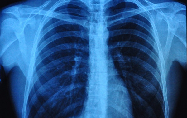 Imagen: La medición, conocida como altura de la cúpula diafragmática (DDH), permite una identificación temprana y sencilla de pacientes con cáncer de pulmón posquirúrgico de alto riesgo con trastorno ventilatorio obstructivo (crédito de la imagen: 123RF) Imagen: La medición, conocida como altura de la cúpula diafragmática (DDH), permite una identificación temprana y sencilla de pacientes con cáncer de pulmón posquirúrgico de alto riesgo con trastorno ventilatorio obstructivo (crédito de la imagen: 123RF)
