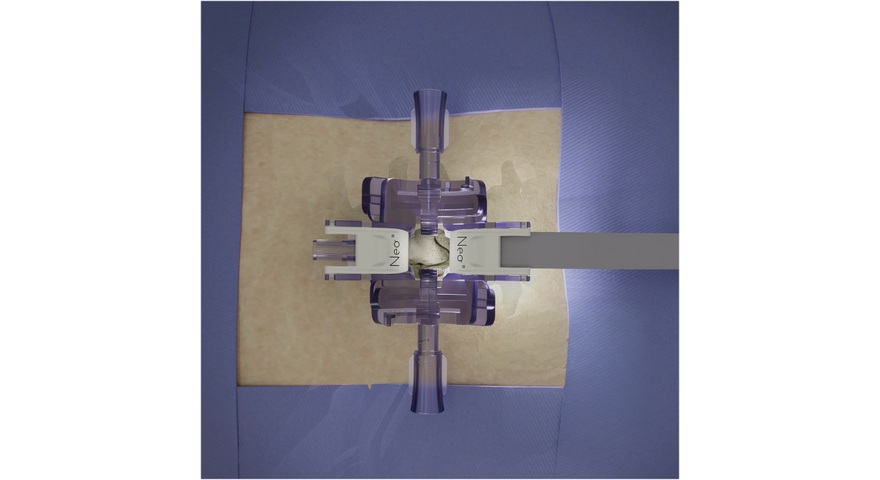 Imagen: Neo Instant MIS Access se retiene automáticamente, lo que elimina la necesidad de brazos de mesa fijos. La plataforma ofrece un canal de trabajo ampliable y adaptable, iluminado por una luz integrada para una visualización clara. (Foto cortesía de Neo Medical SA) Imagen: Neo Instant MIS Access se retiene automáticamente, lo que elimina la necesidad de brazos de mesa fijos. La plataforma ofrece un canal de trabajo ampliable y adaptable, iluminado por una luz integrada para una visualización clara. (Foto cortesía de Neo Medical SA)