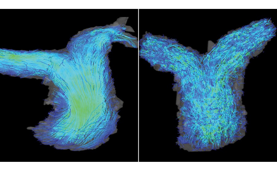 Imagen: Imágenes de RM cardíaca de flujo 4D de la arteria pulmonar en pacientes con ICFEp. Izquierda: un paciente con función normal del ventrículo derecho muestra flujo sanguíneo laminar en la arteria pulmonar. Derecha: un paciente con disfunción del ventrículo derecho que experimenta un flujo sanguíneo turbulento en la arteria. (Crédito de la imagen: Farhan Raza y Oliver Wieben)
