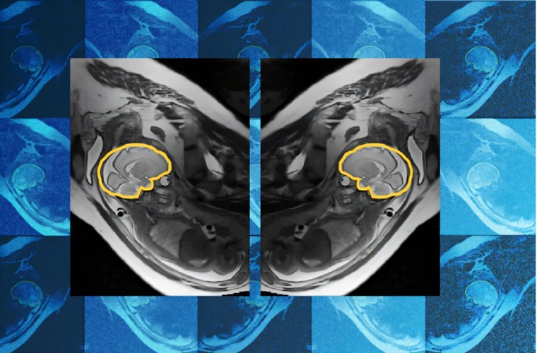 Imagen: Una resonancia magnética de un cerebro fetal (delineado en amarillo) en posición sagital. E(3)-Pose es un modelo que ayuda a rastrear el movimiento en una resonancia magnética del cerebro del feto. El modelo podría ayudar a los médicos a realizar diagnósticos más tempranos y precisos de anomalías del desarrollo. (Crédito de la imagen: MIT Jameel Clinic y los investigadores)