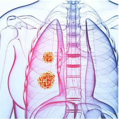 PRUEBA DE CÁNCER DE PULMÓN
