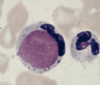 Imagen: Extendido de sangre mostrando una célula LES de un paciente con lupus eritematoso sistémico (Fotografía cortesía del Colegio Imperial de Londres).