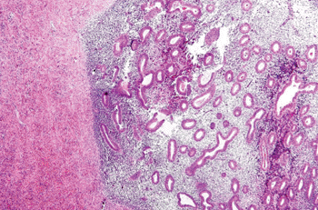 Imagen: Microfotografía de la endometriosis del ovario (Fotografía cortesía de Nephron).