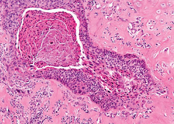 Imagen: Histopatología de un carcinoma escamocelular (Fotografía cortesía de la Universidad Masaryk).