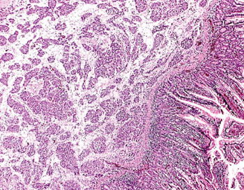 Imagen: Fotomicrografía de una metástasis yeyunal submucosa de un carcinoma escamocelular de esófago (Fotografía cortesía del Dr. Joerg Lindenmann). Imagen: Fotomicrografía de una metástasis yeyunal submucosa de un carcinoma escamocelular de esófago (Fotografía cortesía del Dr. Joerg Lindenmann).