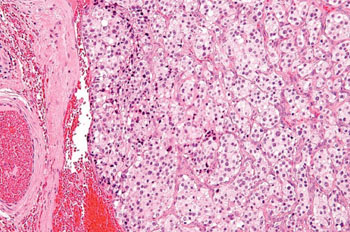 Imagen: Una fotomicrografía de un paraganglioma, un tumor del cuerpo carotídeo (Fotografía cortesía de Nephron)