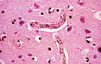 Imagen: Histología de un cerebro de un paciente con malaria cerebral mostrando el secuestro de parásitos, la pigmentación y obstrucción de los vasos sanguíneos (Fotografía cortesía de la Universidad Chulalongkorn).