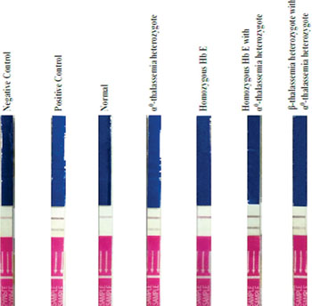 Imagen A: Tira de análisis inmunocromatográfica para la Hb de Bart en muestras de sangre de individuos heterocigotos para α0-talasemia y de individuos doblemente heterocigotos para la HbE homocigota y α0-talasemia y doblemente heterocigotos para la α0β-talasemia (Fotografía cortesía de la Universidad de Mahidol).