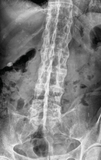 Imagen: Una radiografía mostrando la columna de bambú en un paciente con espondilitis anquilosante (Fotografía cortesía de Steven Fruitsmaak).