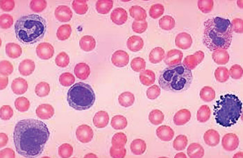 Imagen: Varios tipos de leucocitos en una muestra de sangre usada para un recuento diferencial de glóbulos blancos con el fin de determinar los porcentajes relativos (Fotografía cortesía de la Dra. Kristine Kraft, MD).