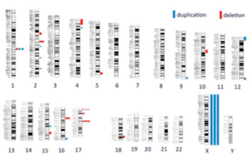 Imagen: Representación de los desequilibrios genómicos detectados en los pacientes con enfermedad renal crónica. Los cromosomas humanos se muestran (numerados). Las barras de colores representan las deleciones genómicas patógenas (rojo) y las duplicaciones (azul) detectadas en un paciente. En total, el estudio identificó 21 lesiones genéticas diferentes en 31 pacientes, lo que indica que la mayoría de los pacientes tenían una patología genómica única. El tamaño de cada barra es proporcional al tamaño de la lesión genómica (Fotografía cortesía del Dr. Ali Gharavi, Universidad de Columbia). Imagen: Representación de los desequilibrios genómicos detectados en los pacientes con enfermedad renal crónica. Los cromosomas humanos se muestran (numerados). Las barras de colores representan las deleciones genómicas patógenas (rojo) y las duplicaciones (azul) detectadas en un paciente. En total, el estudio identificó 21 lesiones genéticas diferentes en 31 pacientes, lo que indica que la mayoría de los pacientes tenían una patología genómica única. El tamaño de cada barra es proporcional al tamaño de la lesión genómica (Fotografía cortesía del Dr. Ali Gharavi, Universidad de Columbia).
