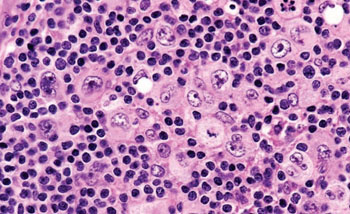 Imagen: Un estudio histopatológico del linfoma de Hodgkin clásico (Fotografía cortesía del Dr. John KC Chan).