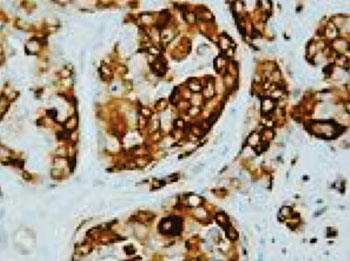 Imagen: Una inmunohistoquímica de la expresión de la proteína αB-cristalina en un tumor de mama humano (Fotografía cortesía de la Universidad de Wisconsin).