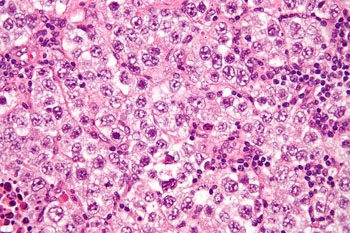 Imagen: Una microfotografía de un seminoma, un tumor de células germinales común (Fotografía cortesía de Wikimedia Commons).