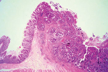Imagen: Un estudio histopatológico de adenocarcinoma de colon compuesto por estructuras glandulares caóticas que están alineadas por una o más filas de células cancerosas con o sin producción de moco (Fotografía cortesía de la Universidad Johns Hopkins).