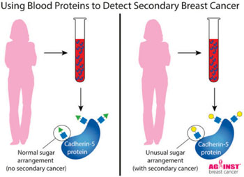 Imagen: Un diagrama de la prueba de sangre diseñada para detectar el cáncer de mama secundario (Fotografía cortesía de Lee Abrey y Nicola Winstone).
