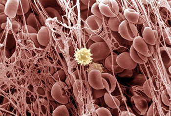 Imagen: Una micrografía electrónica de barrido a color (SEM) de una célula de cáncer de cuello uterino en división (Fotografía cortesía de Wellcome Images).