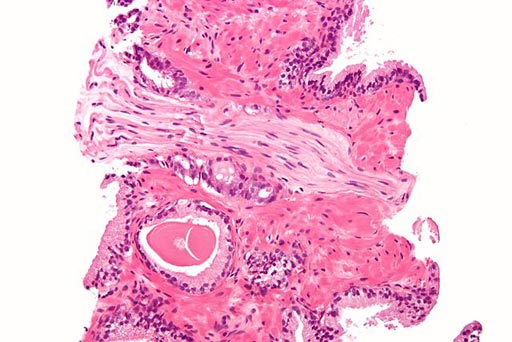 Imagen: Una micrografía de un adenocarcinoma prostático (convencional, tipo acinar) con invasión perineural. Biopsia de próstata, coloración de H&E (Fotografía cortesía de Wikimedia).