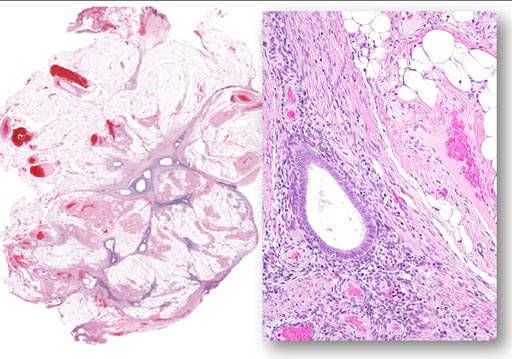 Imagen: Endometriosis en el tejido peritoneal (izquierda) formando una cicatriz. A la microscopía, se compone de glándulas y estroma circundante con inflamación crónica y fibrosis (Fotografía cortesía de Ie-Ming Shih).