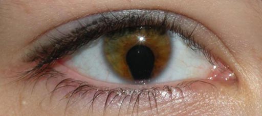 Imagen: Los científicos han identificado una mutación genética que contribuye a la pérdida de visión en los niños (Fotografía cortesía de la Universidad de Edimburgo).