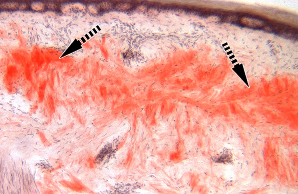 Imagen: Una histopatología de una biopsia de piel en un paciente con amiloidosis. Los grupos de proteínas se muestran en rojo (Fotografía cortesía del profesor Michael Polydefkis).