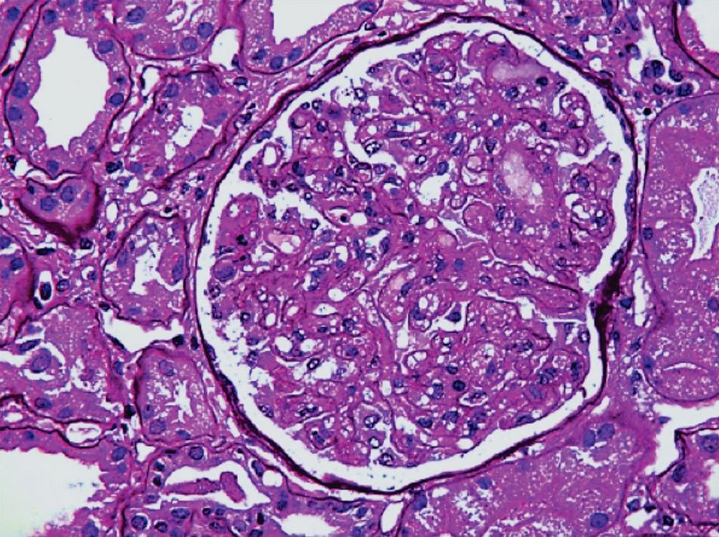 Imagen: Una histopatología del glomérulo de una paciente con preeclampsia que revela una apariencia en forma de burbuja pronunciada en las áreas consolidadas, causadas por las células endoteliales hinchadas y los podocitos (Fotografía cortesía de la Dra. Vivette D\'Agati, MD).